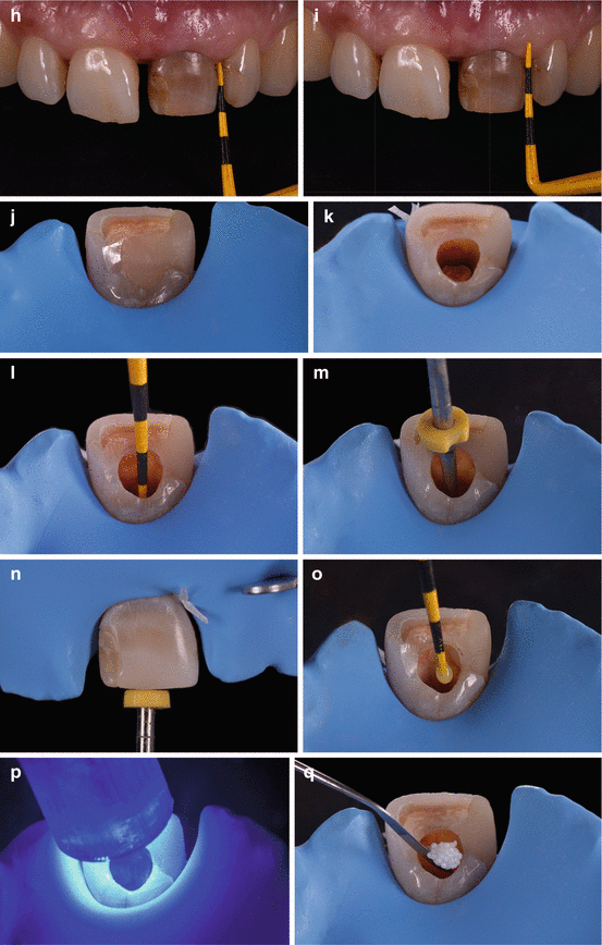 خطوات التبييض الداخلي للأسنان في العيادة